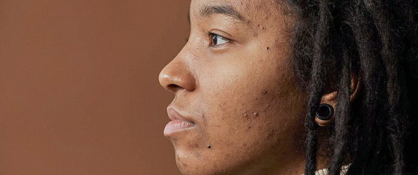 acne job interview