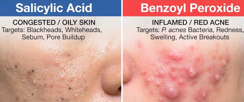 Salicylic acid_skincare with monica